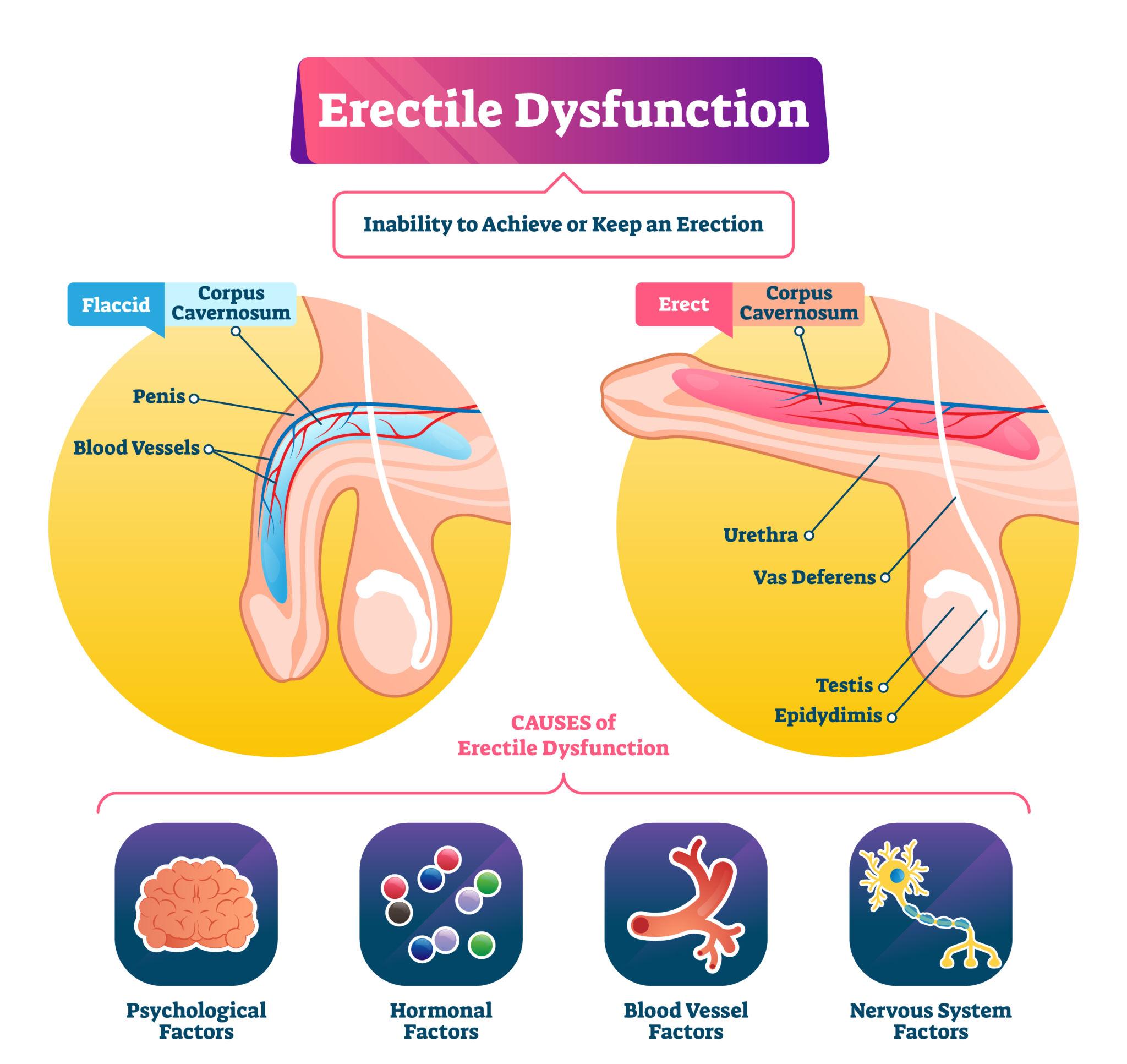 Erectile Dysfunction in Men: Causes, Symptoms & Treatment | Dr. Hisham Hyder